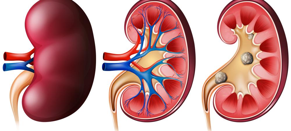 Signs Your Kidneys Might Be in Trouble