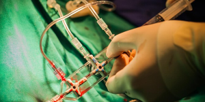 Arterial Switch Operation (ASO)